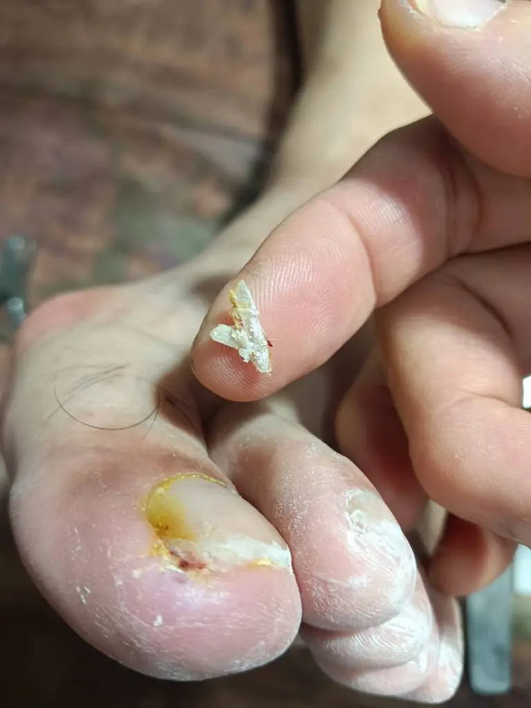 頑固凍甲,嚴重會有陣痛與化膿現象,並非不理他讓它自然長長就不會痛,並非一般指甲剪即可處理