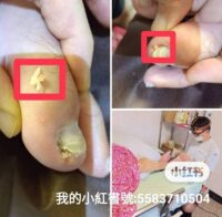專業到府修剪凍甲/嵌甲前後對比圖