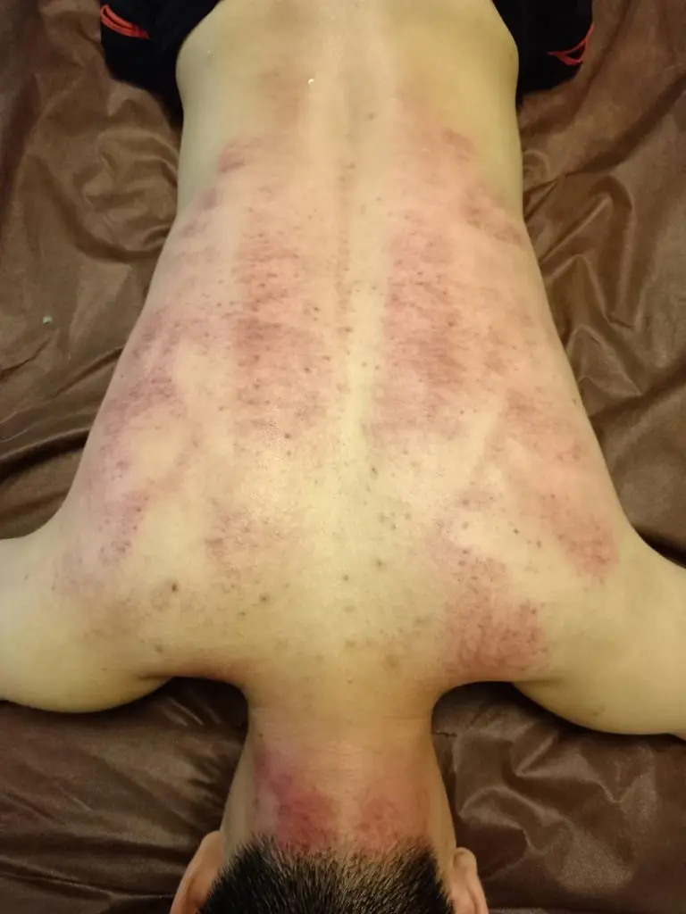 刮痧常用於去除體內濕氣
