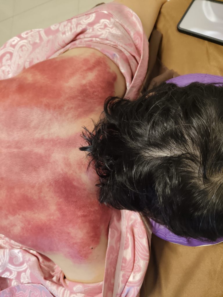 肩頸刮痧,連髮際線部位也特別紅-風池,天柱