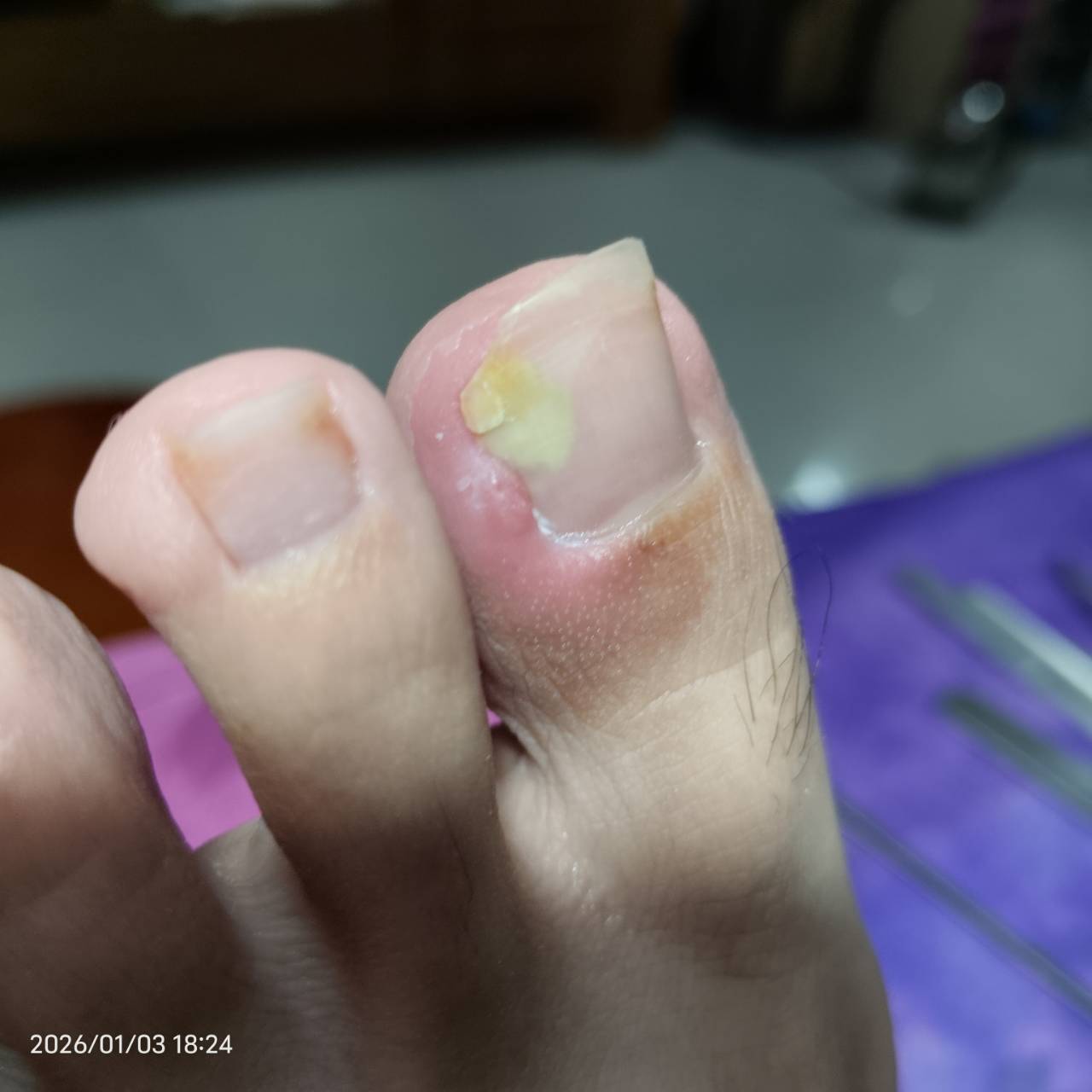 指甲長出肉面-照常凍甲產生