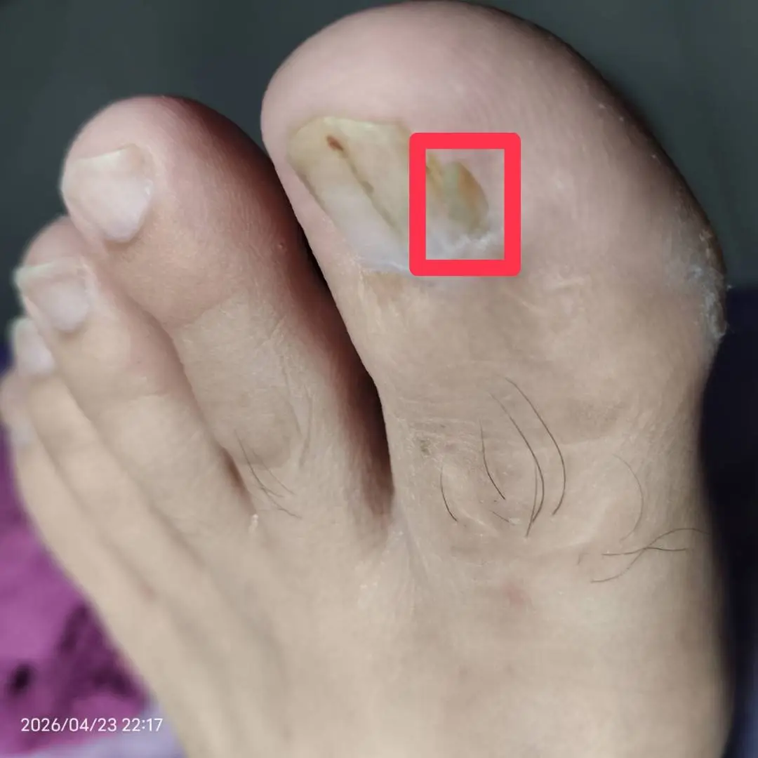 修剪趾甲後影片