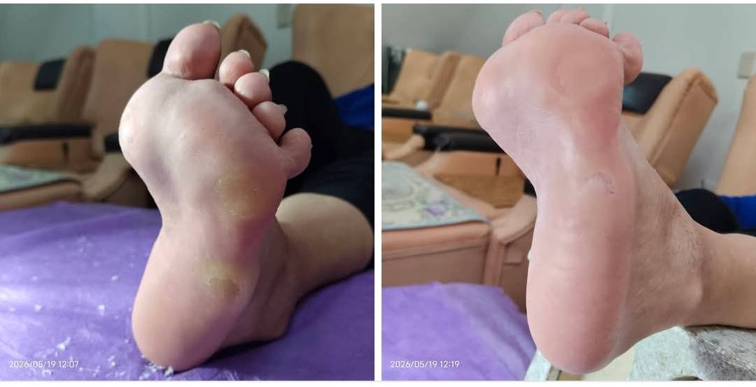 先天高足弓,走路受力不平均導致足繭增生,修腳皮後足底皮膚細嫩,腳底按摩放鬆足底肌肉有效減緩疲勞