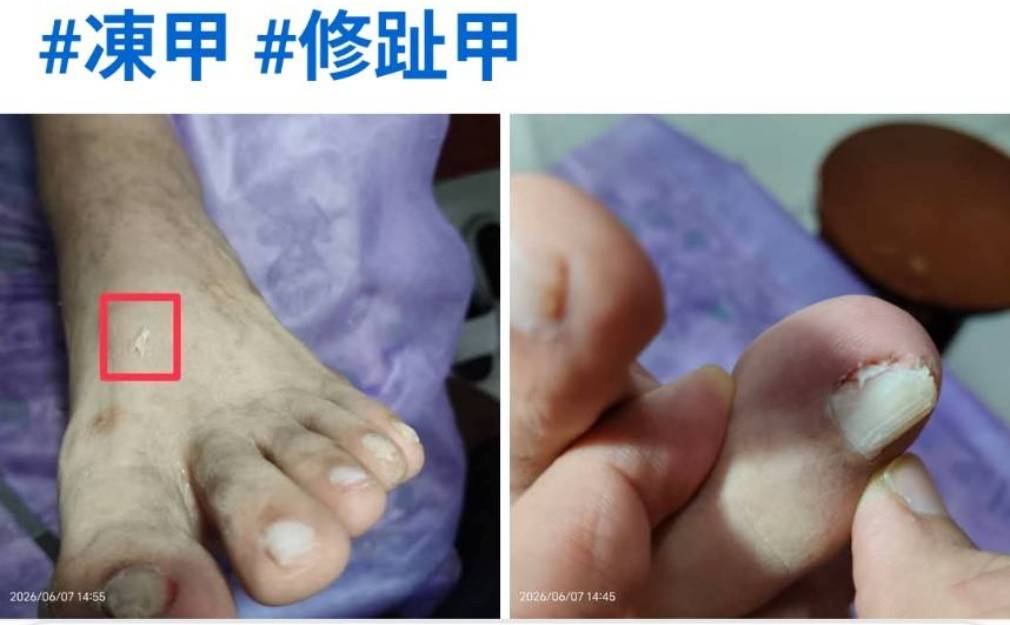 現場照:修客人凍甲現場狀況.
右邊凍甲修剪之前,左邊凍甲修剪之後.凍甲位於指甲最底部,也是最難處理部位