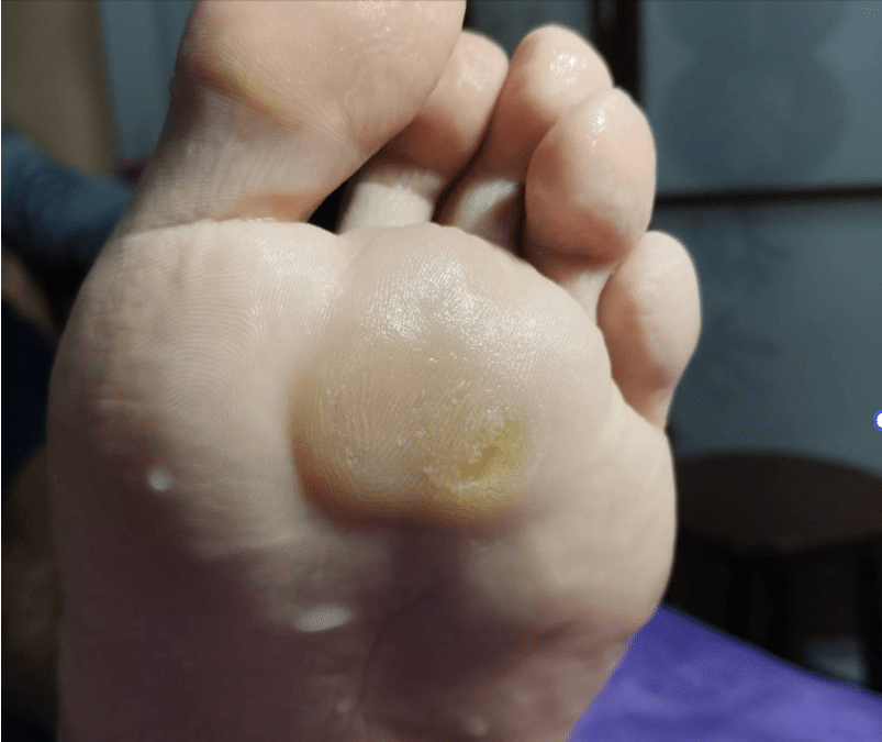 An extra-large corn developed from chronic pressure due to shoes or walking habits, resulting in cellular changes.