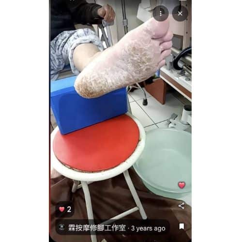Current status of in-home callus removal services