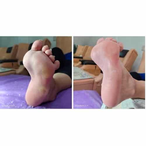 Lin Massage & Foot Care Studio Callus Removal for High Arches and Plantar Discomfort