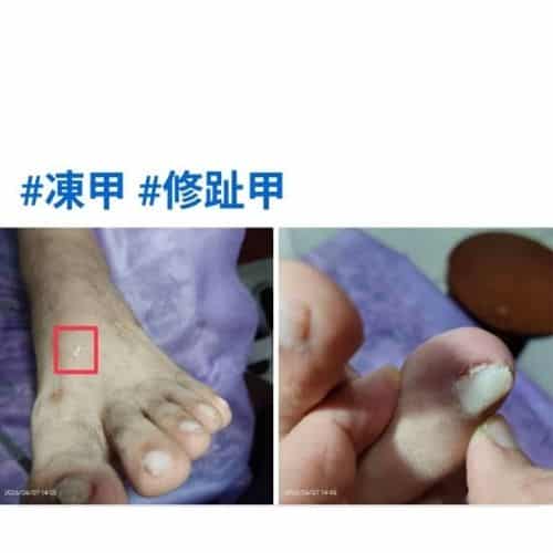 Before and After Ingrown Toenail Relief at Lin's Massage & Pedicure Studio