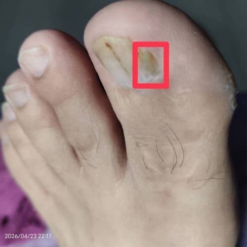Current condition of the patient after undergoing nail bed reconstruction by a physician.